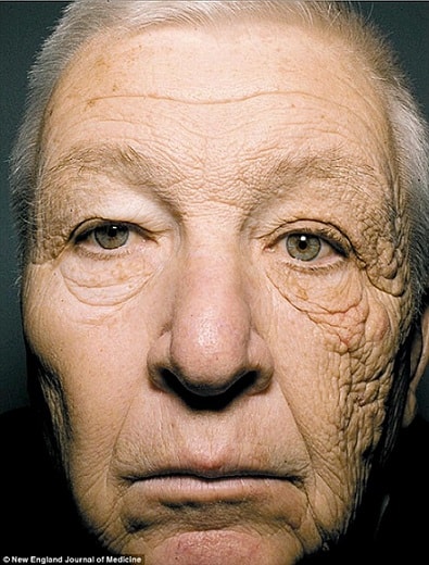 Skin Cancers and Photo Aging